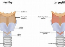 home remedy for laryngitis