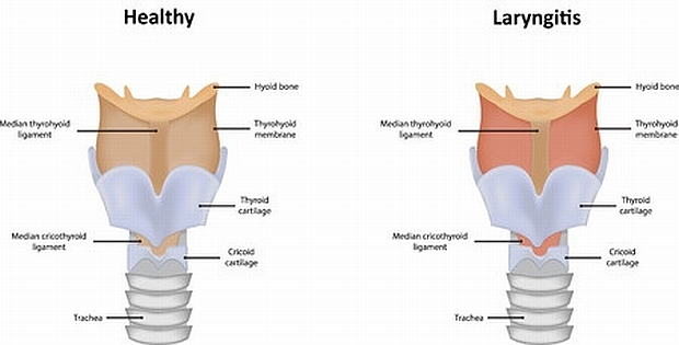 home remedy for laryngitis